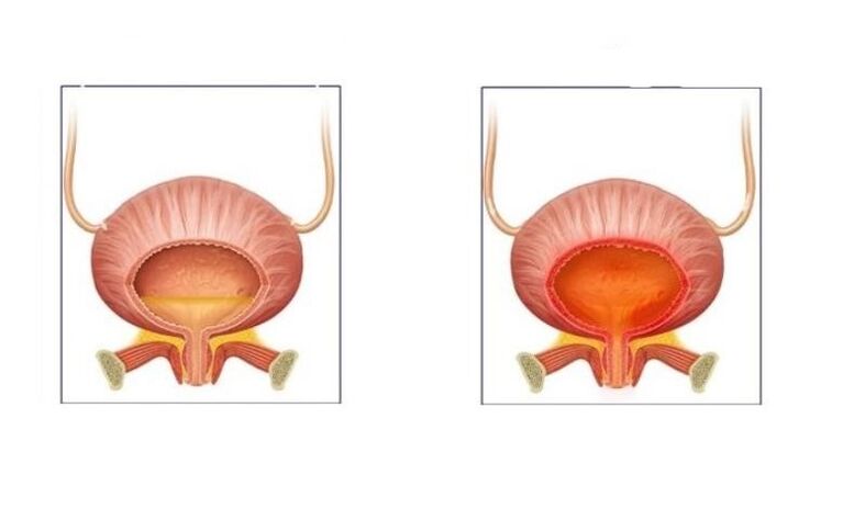 Normal et patients atteints de cystite des voies urinaires