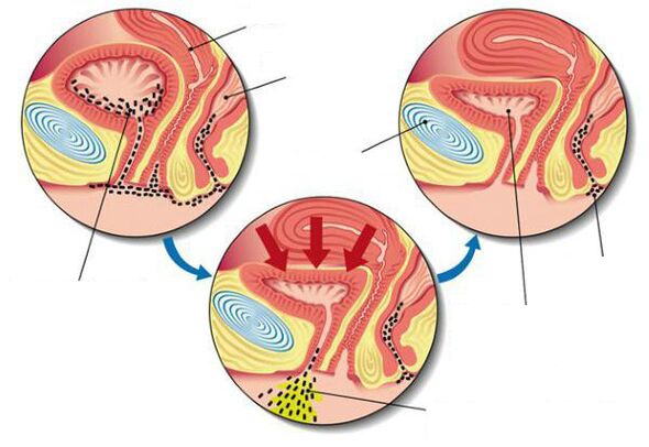 bactéries dans la vessie avec cystite